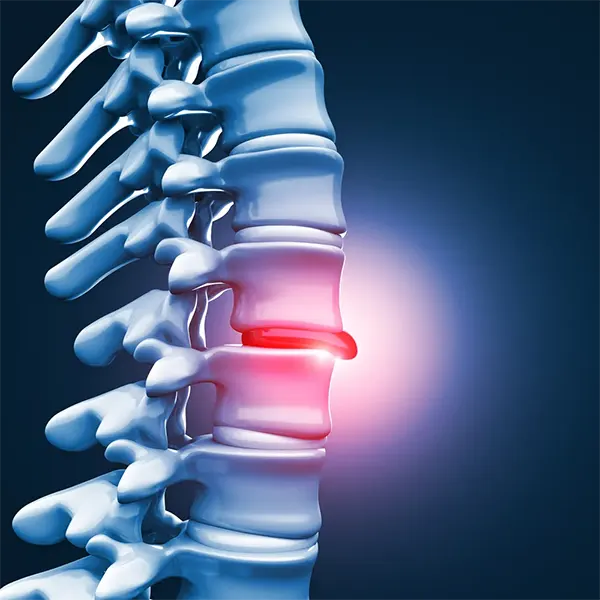Disc Injury Treatment Near Me in Bloomfield Hills, MI. Chiropractor For Disc Injury Pain Relief.